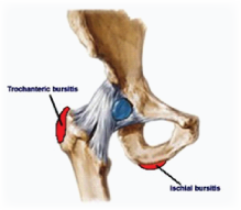 Trochanteric Bursitis 