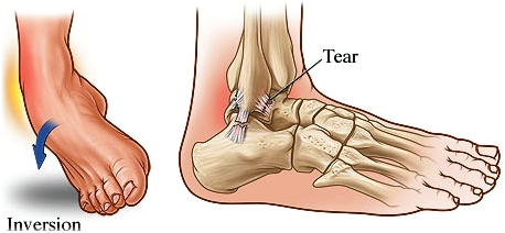 Acute, Chronic and Recurrent Ankle Sprains, Kingsley Physio