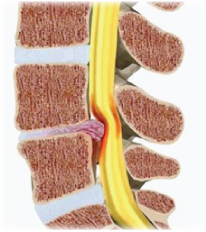 Disc herniation bulge prolapse Kingsley Physio More than your