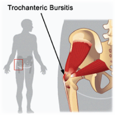 Physical Therapy in Northern Virginia for Trochanteric Bursitis of the Hip