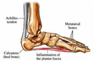 plantar fasciitis