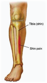 Shin splints (Medial tibial syndrome) | Kingsley Physio | More